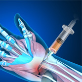 Orthobiologic Treatments for the Wrist Image