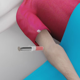 Platelet-Rich Plasma (PRP) Injection Image