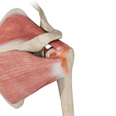 Orthobiologic Treatments for Rotator Cuff Tears Image