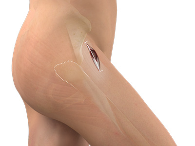 Direct Anterior Total Hip Replacement - Educational Picture