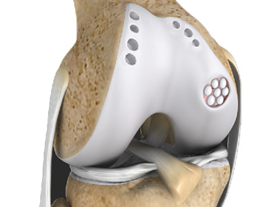 Cartilage Transplant - Educational Picture