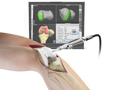 Computer-Assisted Knee Replacement - Educational Picture