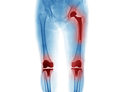 Failed Hip and Knee Replacements - Educational Picture