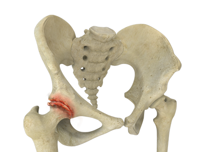 Hip Arthritis - Educational Picture
