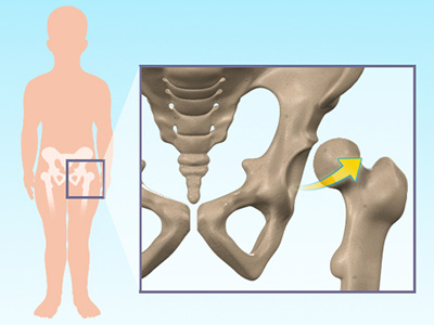 Hip Dysplasia - Educational Picture