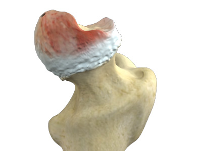 Hip Osteonecrosis - Educational Picture
