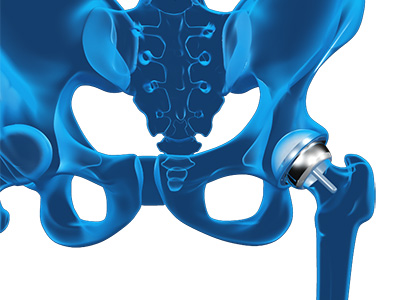 Hip Resurfacing - Educational Picture