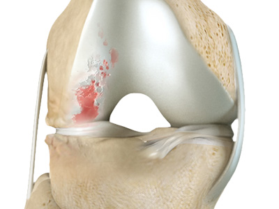 Knee Arthritis - Educational Picture