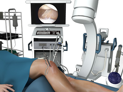 Knee Arthroscopy - Educational Picture