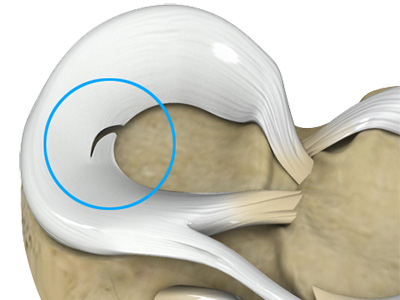 Meniscal Tear - Educational Picture