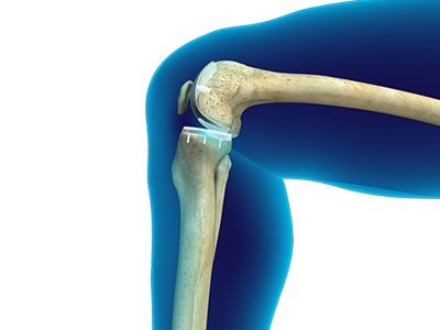 Minimally Invasive Partial Knee Replacement - Educational Picture
