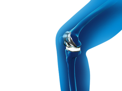 Minimally Invasive Total Knee Replacement - Educational Picture
