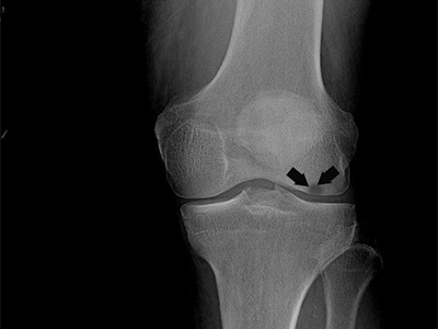 Knee Osteonecrosis - Educational Picture