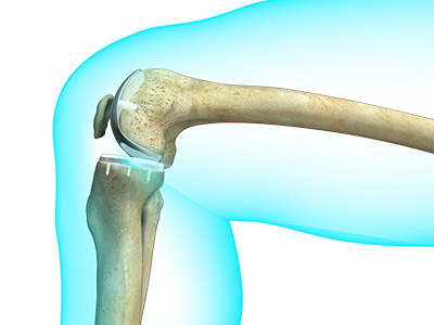 Partial Knee Replacement - Educational Picture