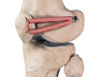 Patellofemoral Replacement - Educational Picture