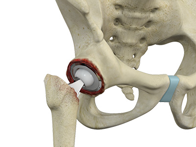Revision Hip Replacement - Educational Picture