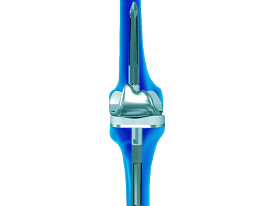 Revision Knee Replacement - Educational Picture