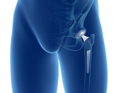 Total Hip Replacement - Educational Picture