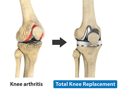 Total Knee Replacement - Educational Picture