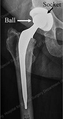 Hip Introduction - Educational Picture