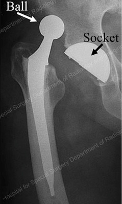 Hip Dislocation - Educational Picture