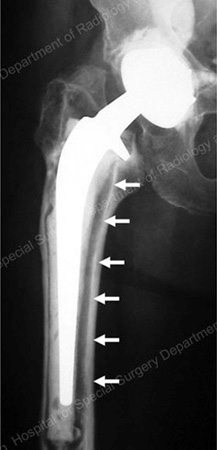 Hip Failure - Educational Picture
