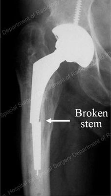 Total Hip Replacement - Educational Picture
