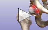 Hip Revision - Educational Picture