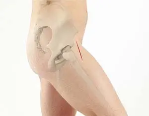 Anterior Hip Replacement pic