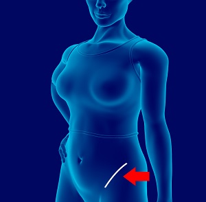 Bikini Incision Hip Replacement pic