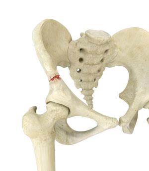 Hip and Pelvis Fracture Surgery pic