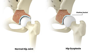 Treatment Of Hip Dysplasia In Adults pic