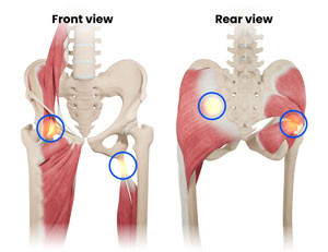 Hip Tendon Injuries pic