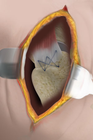 Open Gluteus Medius Repair pic