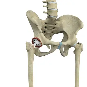 Revision Hip Replacement pic