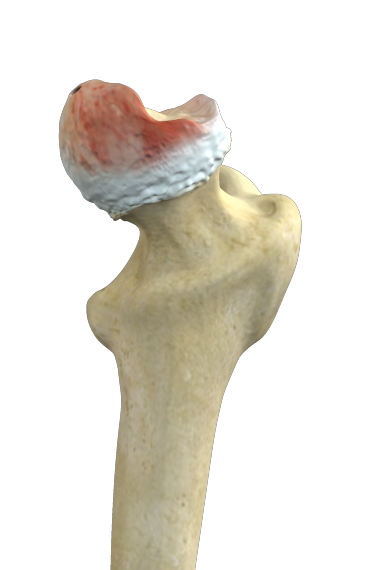 Hip Osteonecrosis Images