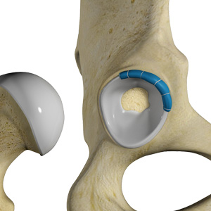 Hip Trauma Reconstruction Images
