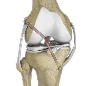 Knee Ligament Reconstruction Images