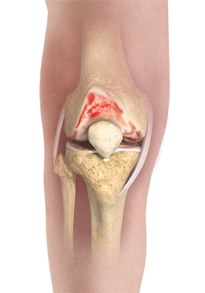 Knee Osteoarthritis Images