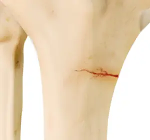 Knee Stress Fractures Images