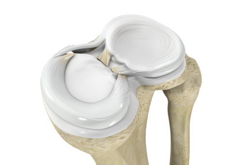 Meniscal Injuries Images