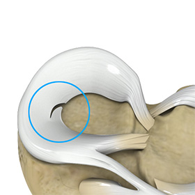 Meniscal Tears Images