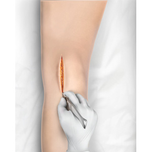 Minimally Invasive Knee Joint Replacement Images