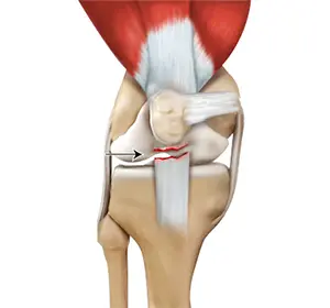 Patellar Tendon Tear Images