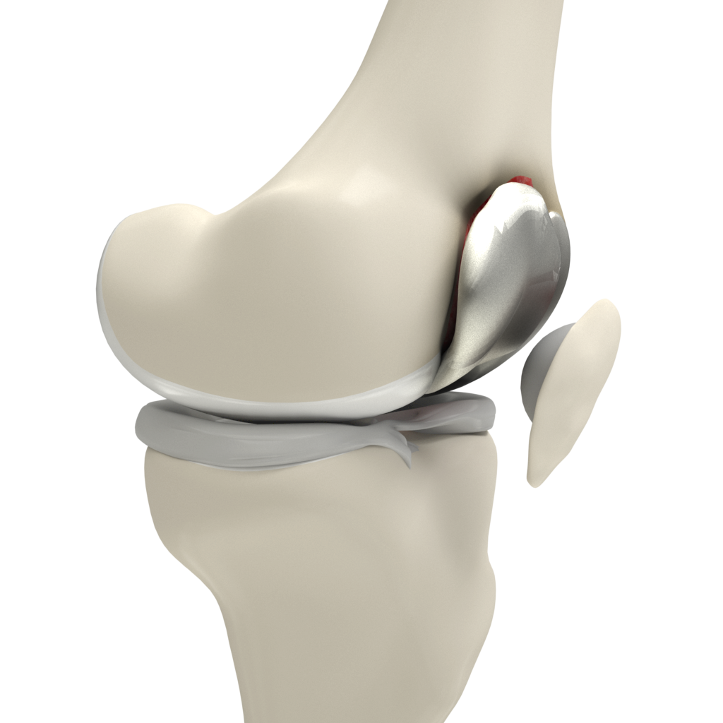 Patellofemoral Knee Replacement Images