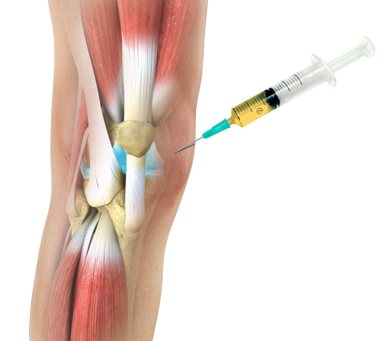 Platelet Rich Plasma (PRP) Injections for the Knee Images