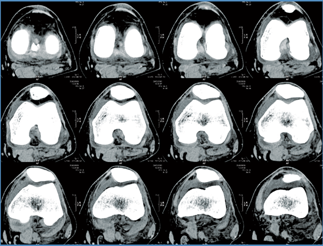 Knee CT Scan