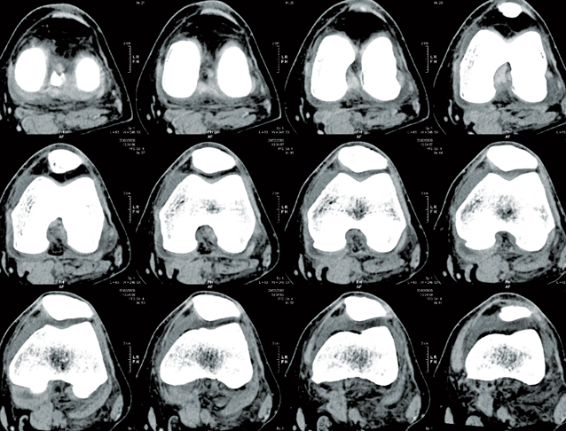 Knee CT Scan