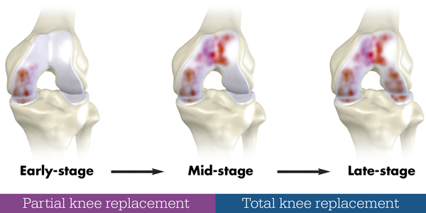 Partial Knee replacement