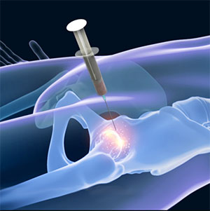 Picture of Bone Marrow Aspirate Concentrate (BMAC) Treatment